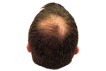 How Does Dihydrotestosterone (DHT) Cause Hair Loss?