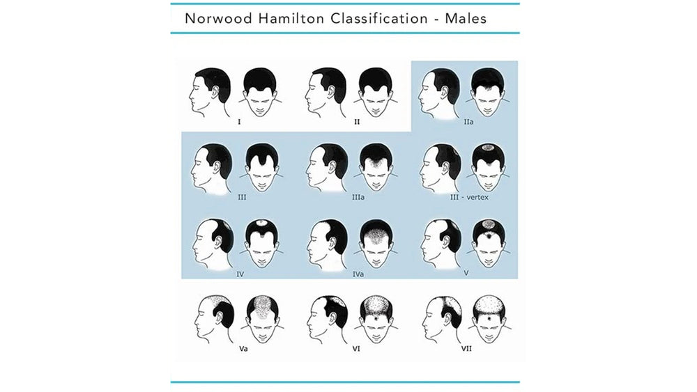 The Hamilton-Norwood Scale for Men