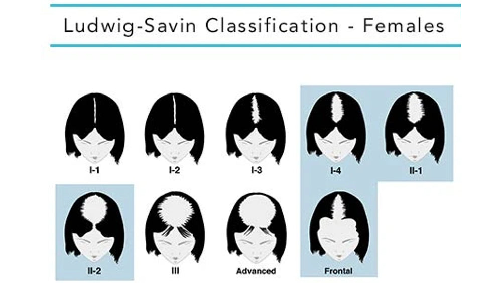 Female Pattern Baldness: Causes, Stages & Effective Treatments 2 Stages of Female Pattern Baldness